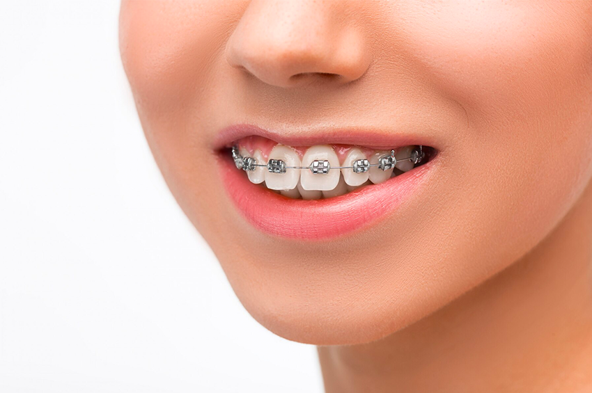 Transform Your Smile with Dental Braces at Vital Dental Care in Dwarka